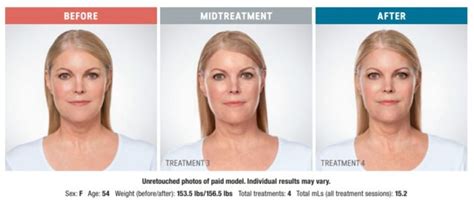 kybella reno|Kybella in Reno, Sparks & Hidden Valley, NV Reno NV